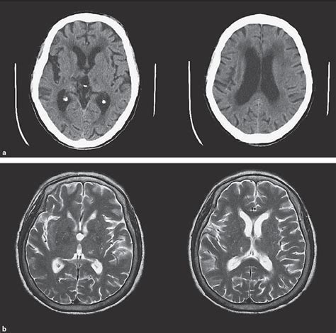 Fig. 1. a An example brain CT of multi-infarct dementia. The brain CT ...