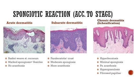 4- Spongiotic Dermatitis - YouTube