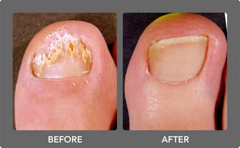 Fungal Nail Laser Treatment – Chiropody Feet First