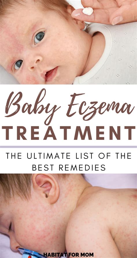 Best Remedies for Baby Eczema (ultimate list) | Habitat for Mom | Baby eczema remedies, Baby ...