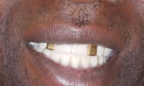 Gold teeth on a natural looking denture Before & After Photos | Gretna LA