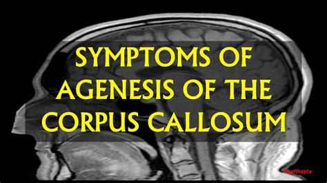 SYMPTOMS OF AGENESIS OF THE CORPUS CALLOSUM - YouTube