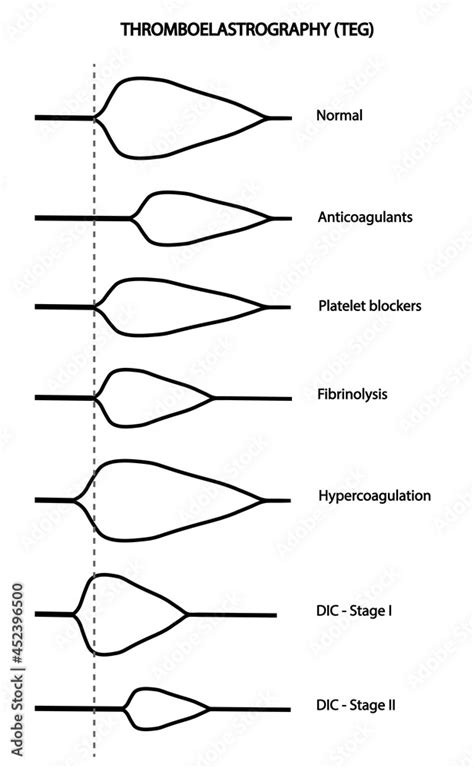 Thromboelastography (TEG). Blood coagulation analysis types. Different types of results Stock ...