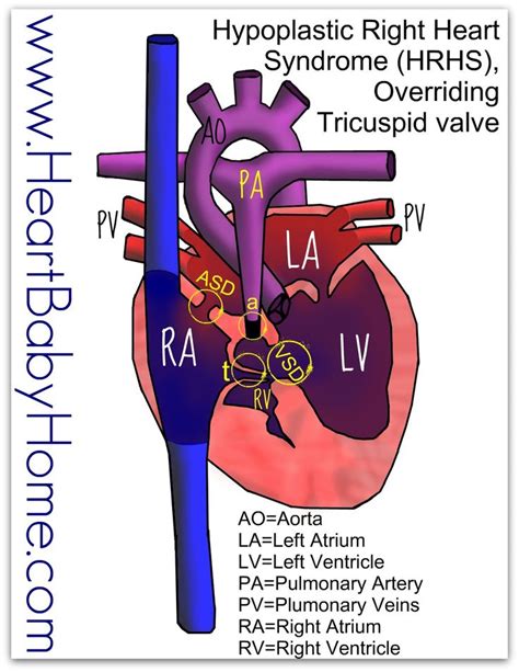 27 best Hypoplastic Right Heart Syndrome images on Pinterest | Cardiovascular disease ...