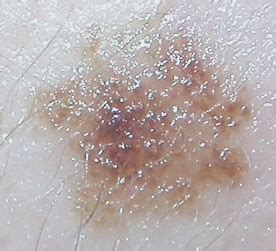 Melanoma – Skin Repair