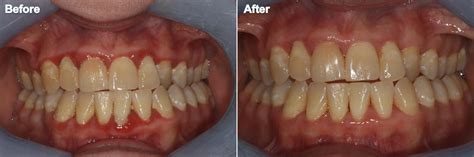 Dental Images Before and After in Indianapolis, IN | Sonrisa Dental