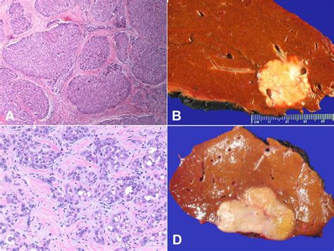 Fibronodular hepatocellular carcinoma—a new variant of liver cancer ...