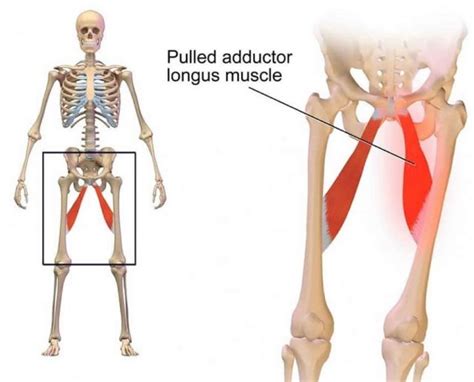 Adductor Injury - Running Tips for Chubby People | The Chubby Runner