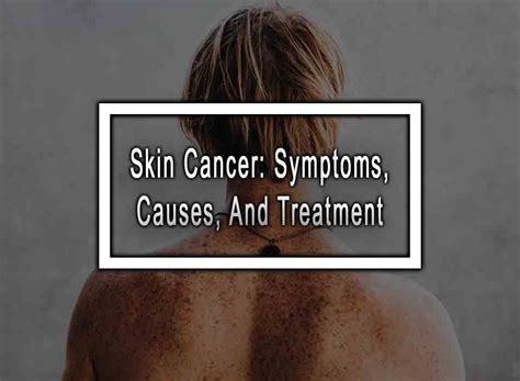 Skin Cancer: Symptoms, Causes, And Treatment