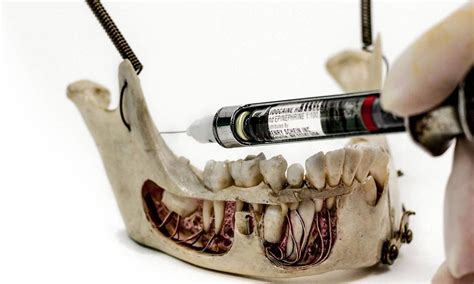 DENTAL ANESTHESIA : Mandibular Block for Pediatric Patients - Dental Injection Technique ...