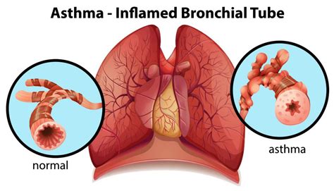 Severe Asthma in Children – Pediatric Pulmonologists in Plano