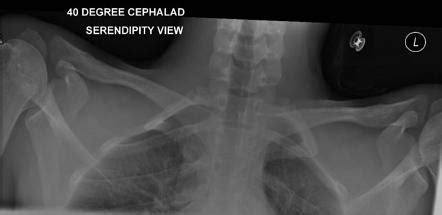 Sternoclavicular joint series | Radiology Reference Article | Radiopaedia.org