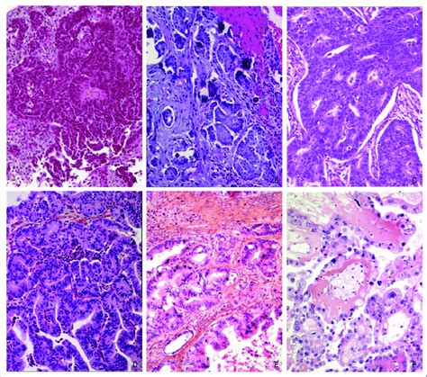 Histopathology of ovarian epithelial tumors. A, high-grade serous... | Download Scientific Diagram