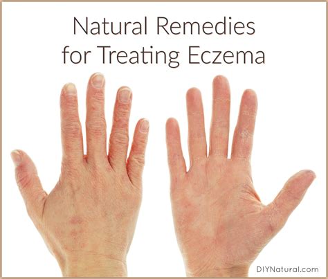 Natural Remedies for Eczema: Both Internal and External Tips