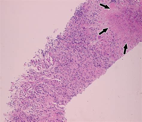 Necrotizing Granuloma of the Lung: Imaging Characteristics and Imaging ...