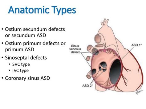 Atrial Septal Defect