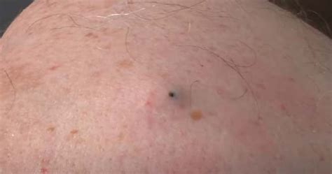 Huge Blackhead On The Back Removed - New Pimple Popping Videos