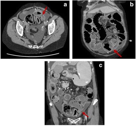 CT abdomen showing closed-loop small bowel obstruction, with multiple... | Download Scientific ...