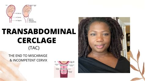 TRANSABDOMINAL CERCLAGE FOR INCOMPETENT CERVIX & MISCARRIAGES #ttc #miscarriages - YouTube