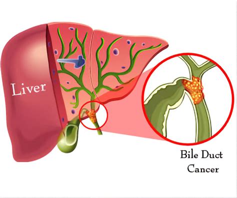 Pancreatic Cancer Blocking Bile Duct - CancerProTalk.com