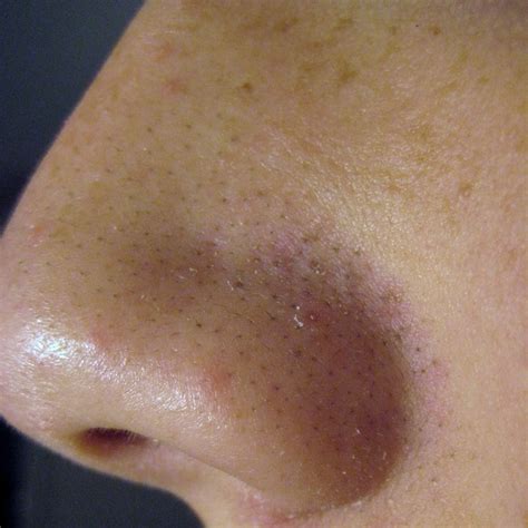 Blackheads and Large Pores — Advanced Dermatology