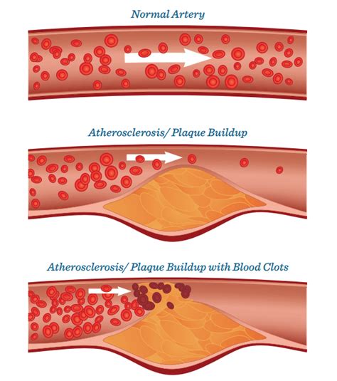 Artery Hardening Problems Caused by Atherosclerosis - Health resolution