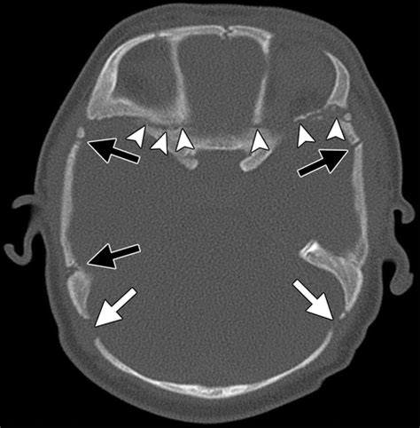 CT of Normal Developmental and Variant Anatomy of the Pediatric Skull ...