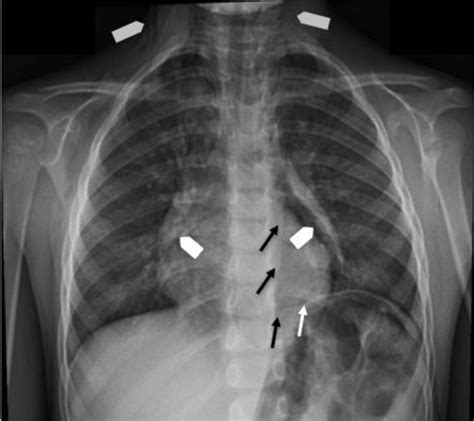 Pneumomediastinum and subcutaneous emphysema: a rare cause of odynophagia | BMJ Case Reports