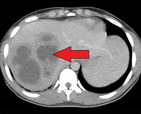 Liver abscess causes, symptoms, diagnosis, treatment & prognosis