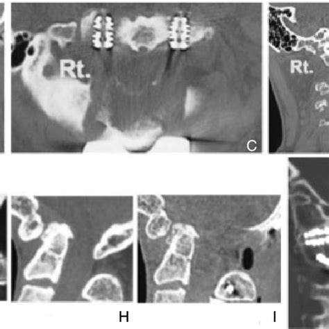 A: Photograph showing lift of the Halo vest gantry, B: Pre-traction, C ...