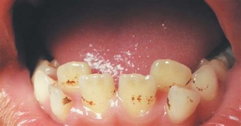 How to Remove Brown Stains from Teeth? - 2023 - Meds Helper