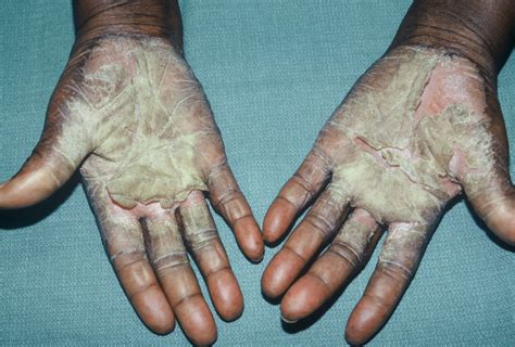 Dyshidrotic Dermatitis On Hands