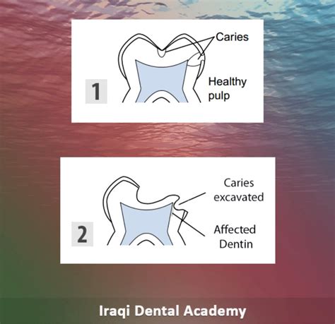 Indirect Pulp Capping Procedure