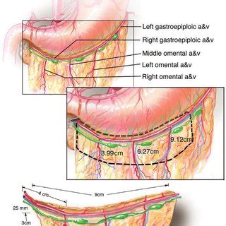 Characteristics of the Right Gastroepiploic Artery and Its Lymph Nodes ...