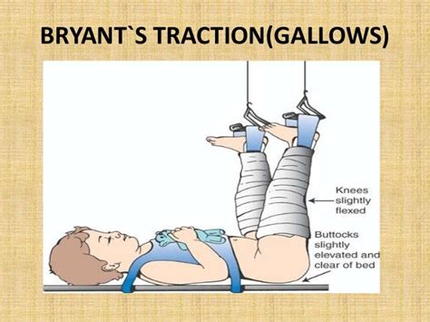 PPT ON TRACTIONS IN ORTHOPAEDICS