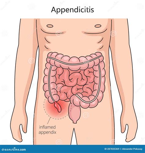 Appendicitis Inflammation of Appendix Medical Stock Illustration - Illustration of body ...