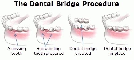 Dental Bridges Galway, Ireland - Galway Dentists