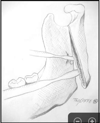 Orthodontic Corner: Mandibular deviation and canted maxillary occlusal plane treated with ...