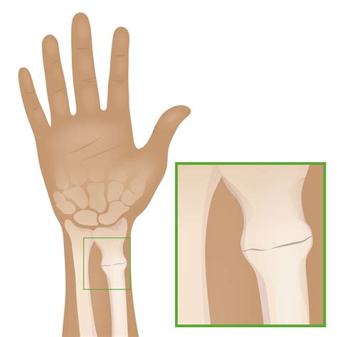 Fractura en Rodete o Tipo Torus | Concise Medical Knowledge