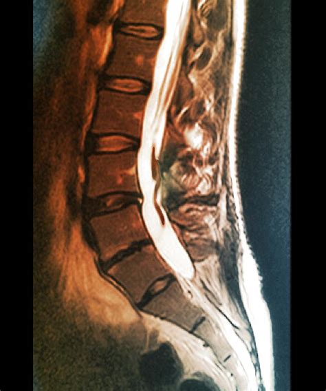 Spinal Arachnoiditis by Zephyr/science Photo Library