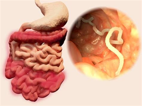 Ocular cysticercosis: symptoms and treatment