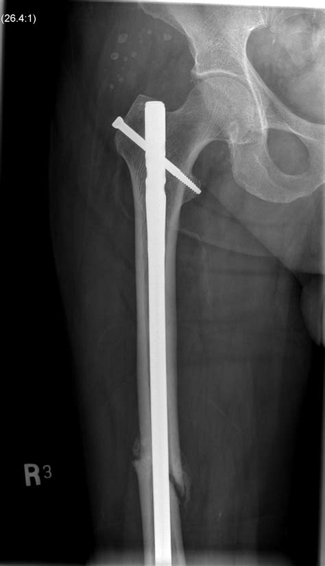 Femoral Shaft Fractures | The Bone School