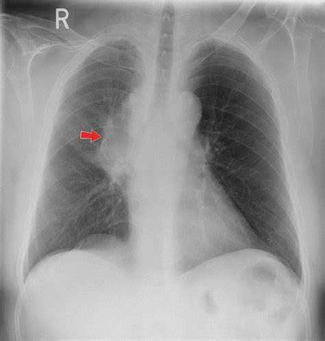 Chest X-ray showing right hilar mass with perihilar opacity (red arrow). | Download Scientific ...