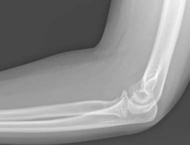 Coronoid Process Radiograph