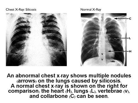 Silicosis