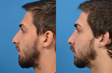 Rhinoplasty Photos | Melbourne, FL | Patient 15626