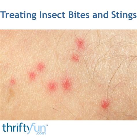 Treating Insect Bites and Stings | ThriftyFun