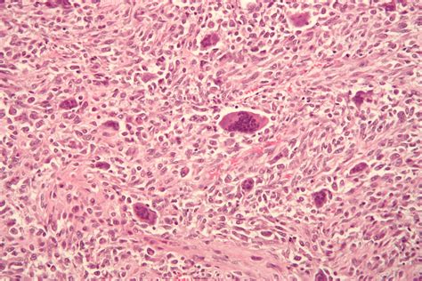 Osteosarcoma