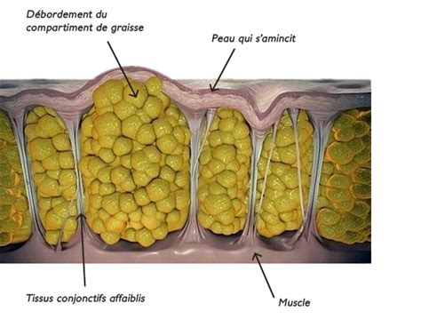 Traitement Anti Cellulite Efficace | Système Médical RF D-Actor