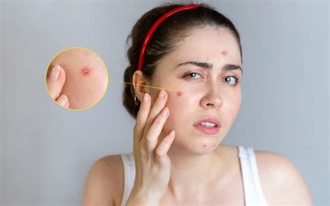 How To Treat Pustules On Face? – SkinKraft